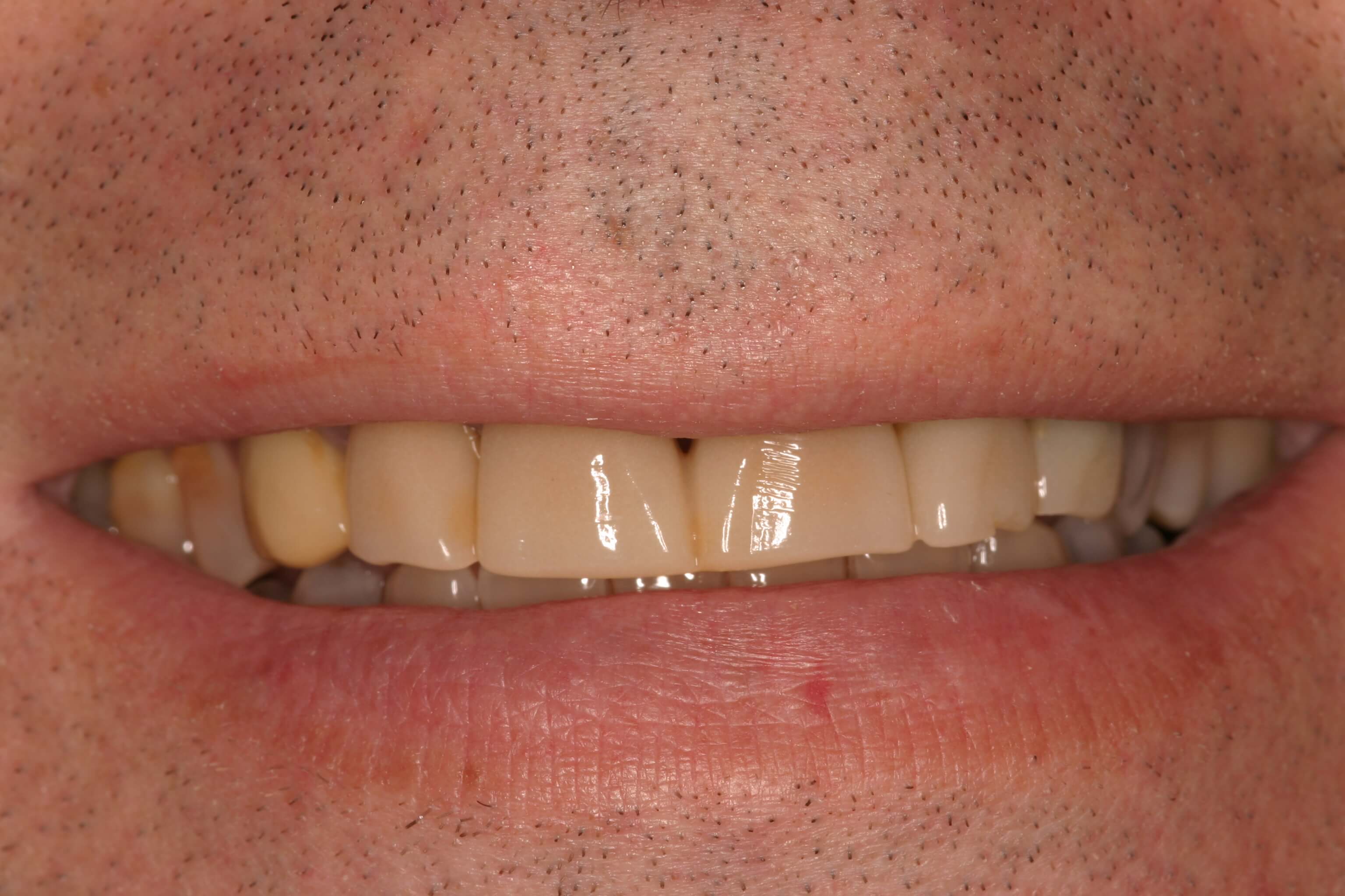 Porcelain Veneers - Before Photo