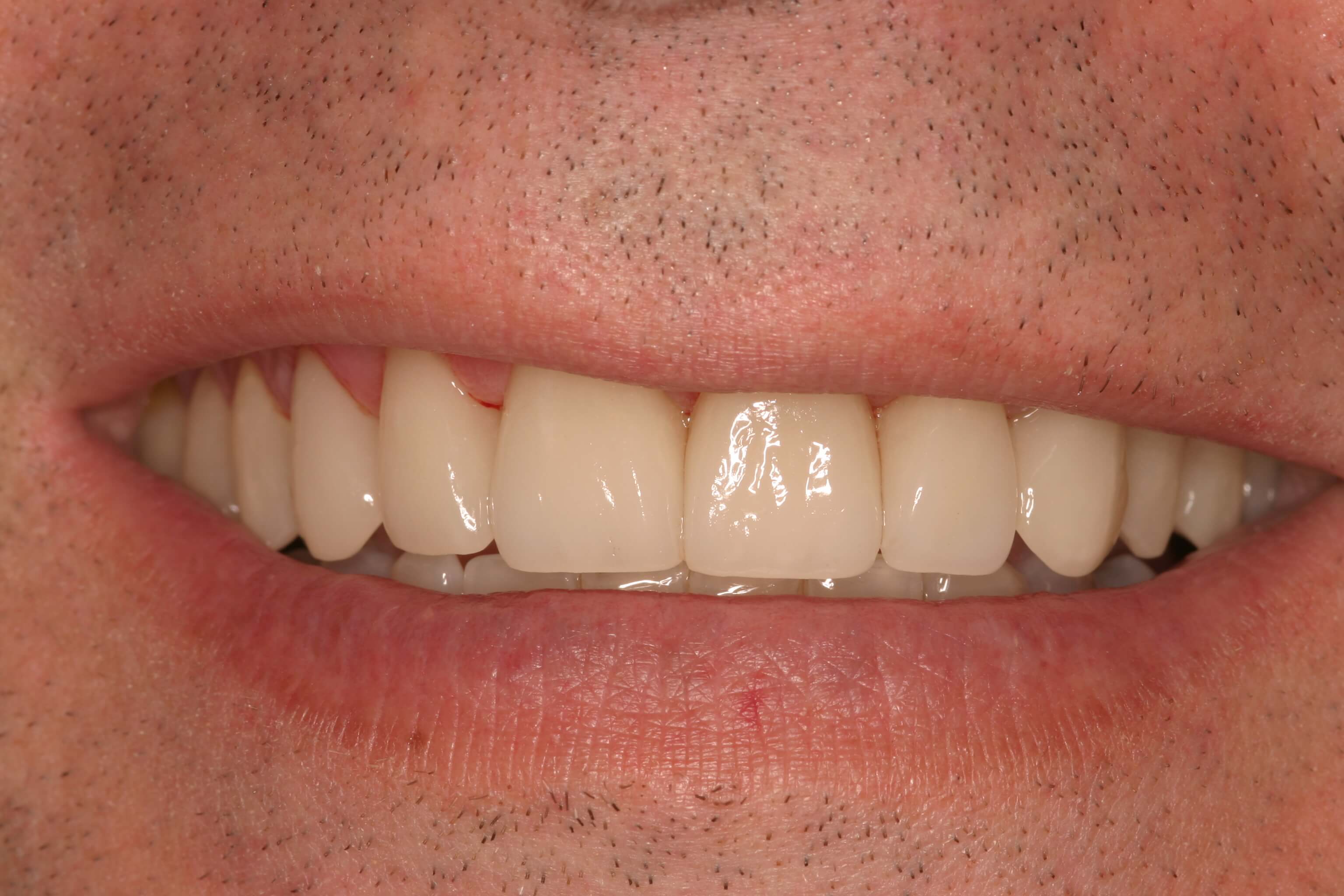 Porcelain Veneers - After Photo