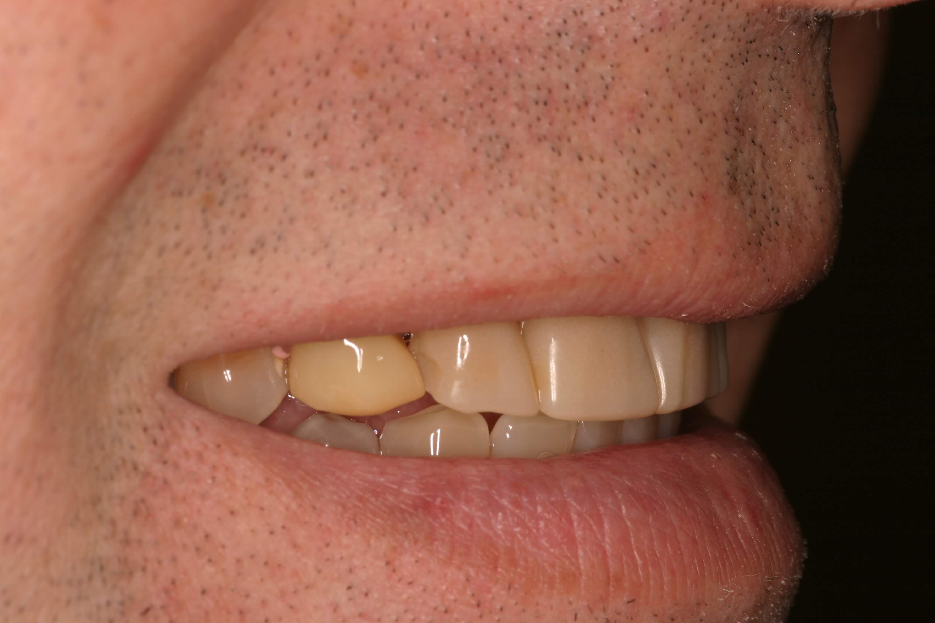 Porcelain Veneers - Before Photo