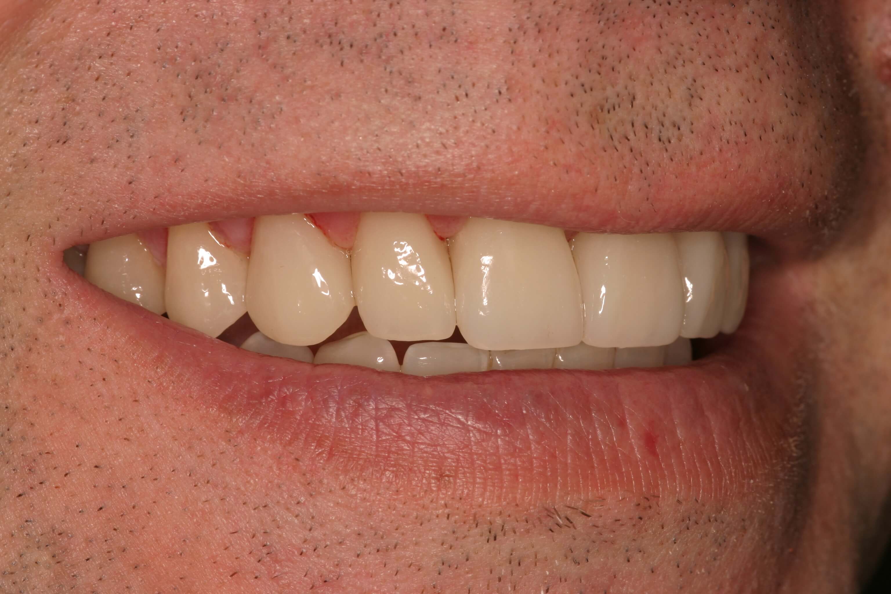 Porcelain Veneers - After Photo
