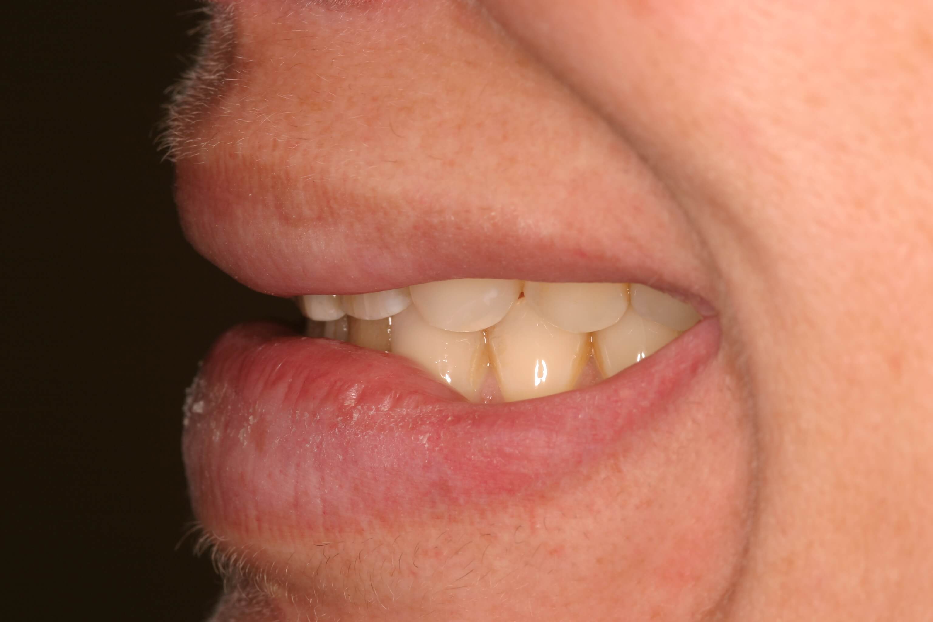 Porcelain Veneers - Before Photo
