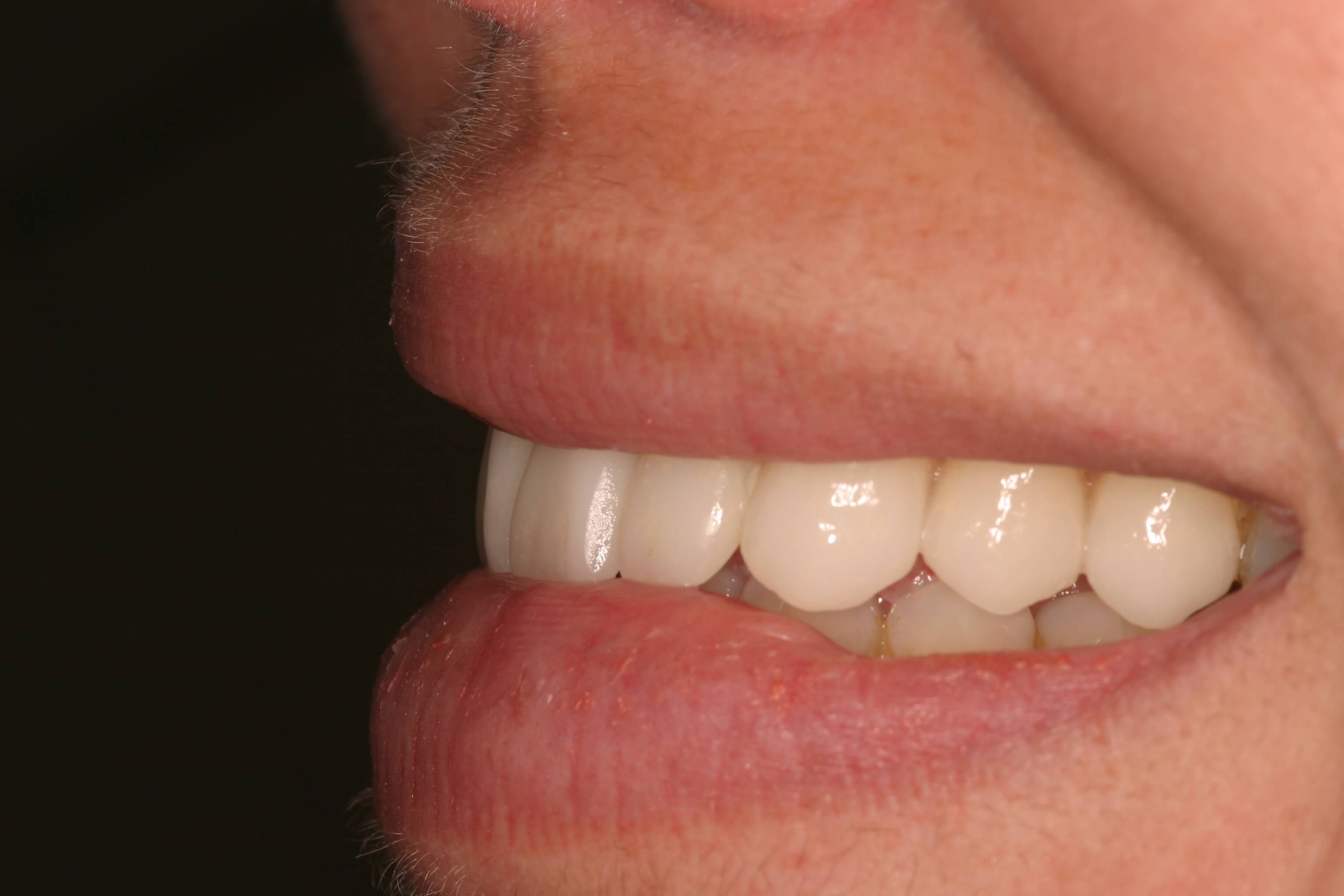 Porcelain Veneers - After Photo