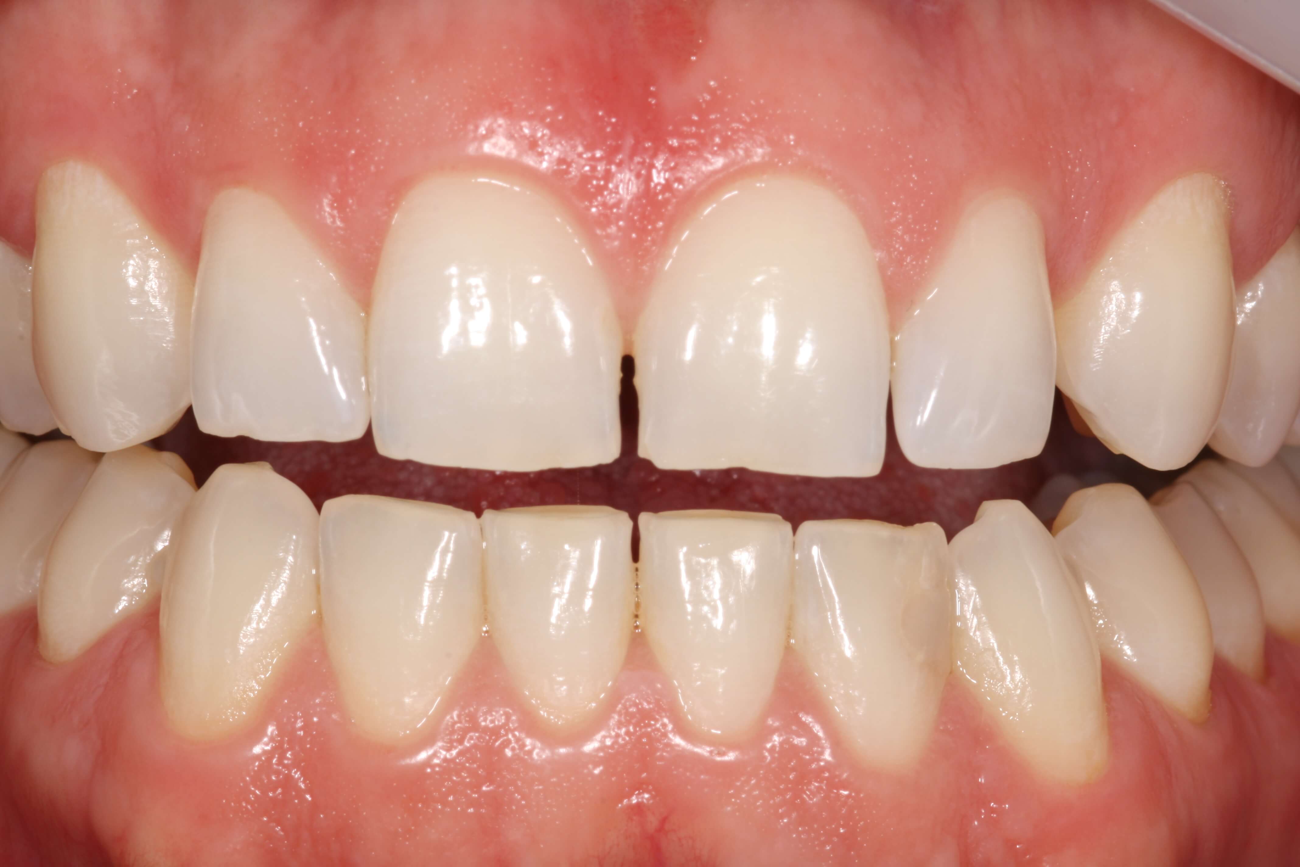 Porcelain Veneers - Before Photo