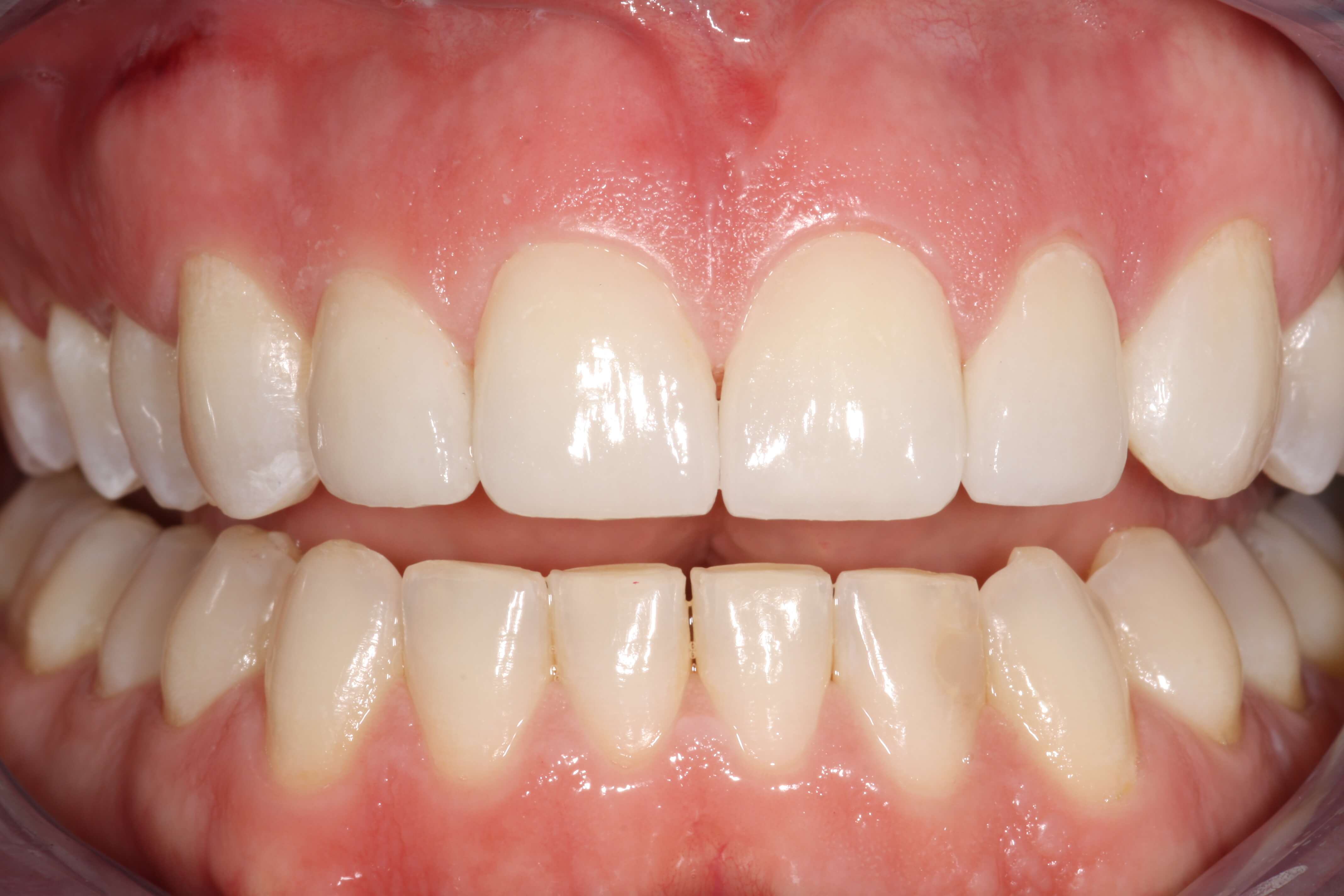 Porcelain Veneers - After Photo